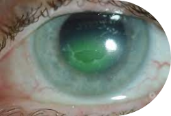 persistent non-healing corneal defect