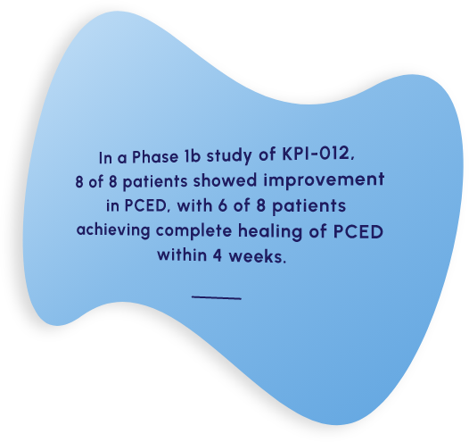 In a Phase 1b study of KPI-012, 8 of 8 patients showed improvement in PCED, with 6 of 8 patients achieving complete healing of PCED within 4 weeks.